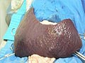 Splenomegali (Pembengkakan Limpa) dan Penanganannya